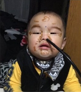 鼻に聴診器のホースを突っ込まれている赤ちゃんの写真